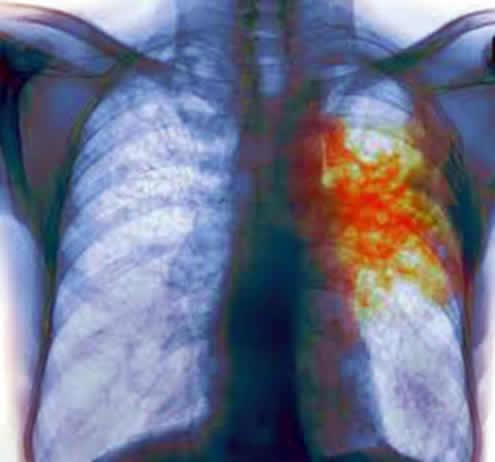 В астраханском лицее обнаружен туберкулез