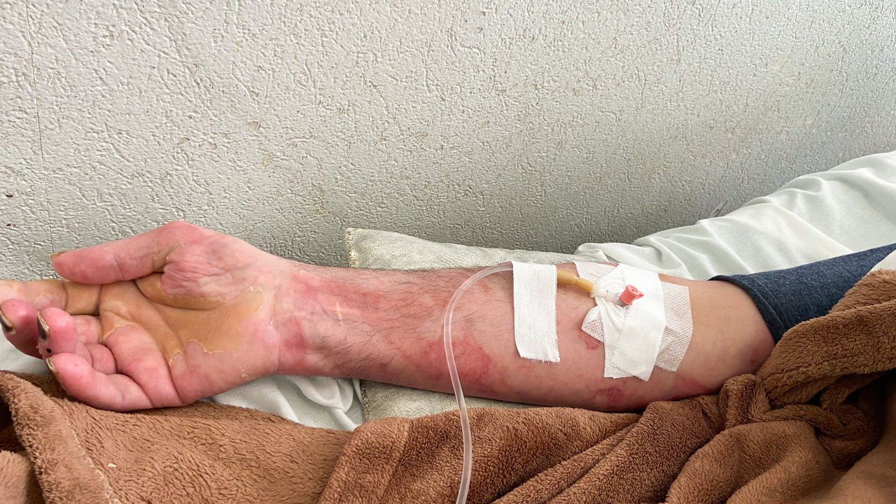 Астраханские медики спасли жизнь мужчине с 90 процентами ожогов тела