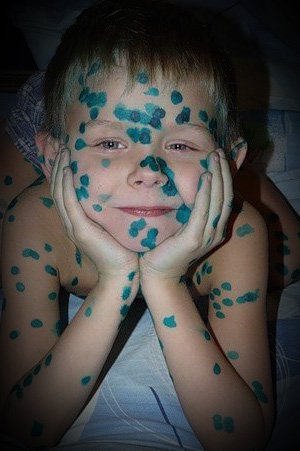 За три месяца корью заболели 237 астраханцев