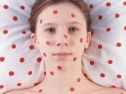 В АСТРАХАНСКОЙ ОБЛАСТИ УЧАСТИЛИСЬ СЛУЧАИ КОРИ.