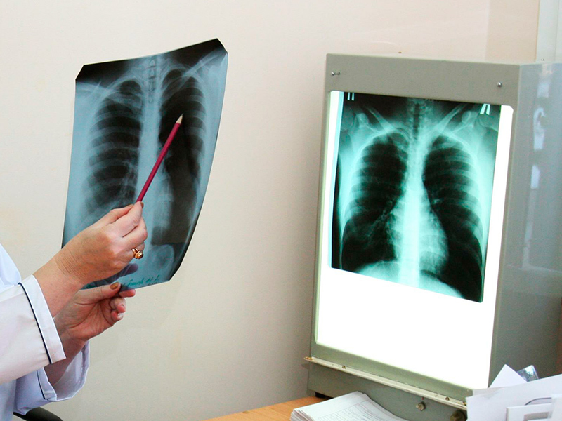 В Астраханской области стали чаще умирать от туберкулёза