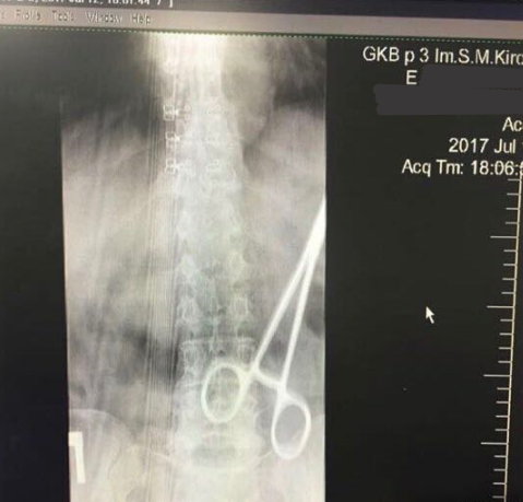 Медиков отстранили от должностей за забытый в теле астраханки зажим