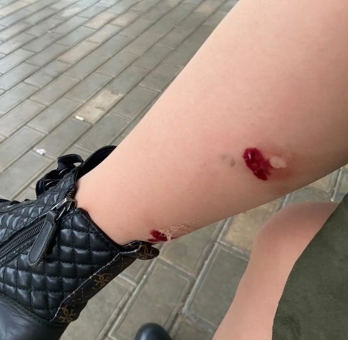 На астраханку набросилась стая собак, ее покусали 