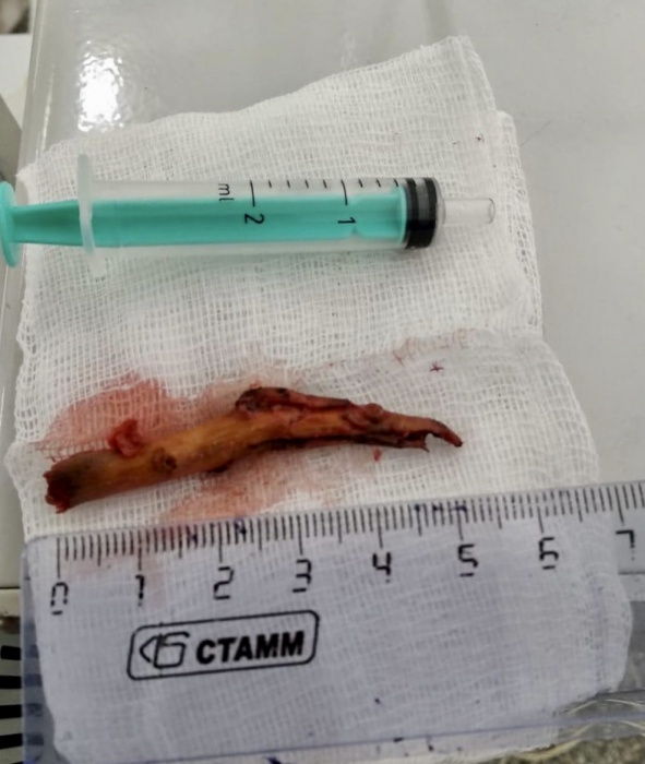 Врачи Александровской больницы достали у пациента из глаза 5-сантиметровую ветку