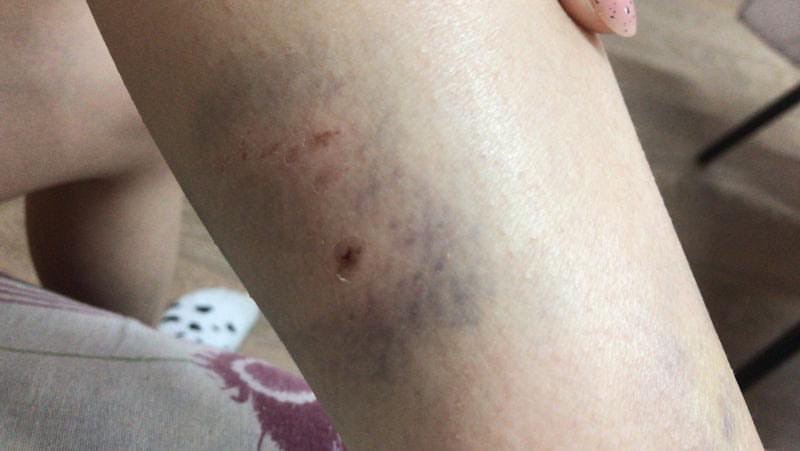 В Астрахани стая собак набросилась на ребенка и покусала его