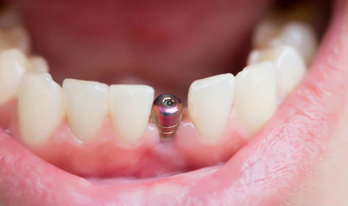 В астраханской стоматологии пациентке вставили поддельные импланты, из-за которых она потеряла почти все зубы