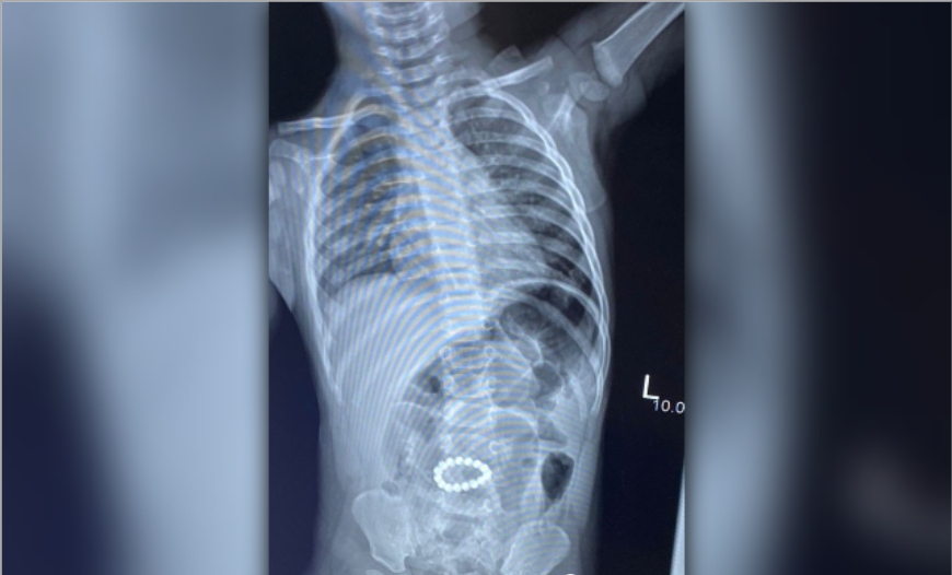 Астраханские медики достали из желудка ребенка 16 магнитов
