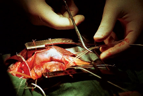 В СЕРДЦЕ АСТРАХАНИ. Наши врачи первыми в России освоили уникальную операцию на сердце