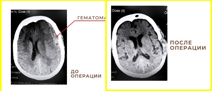 Врачи спасли 86-летнюю астраханку от тяжелого инсульта, удалив у нее огромную гематому
