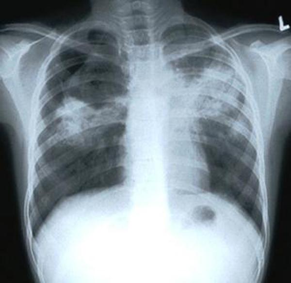 Астраханцы, больные туберкулезом, не лечатся, а врачи и не настаивают