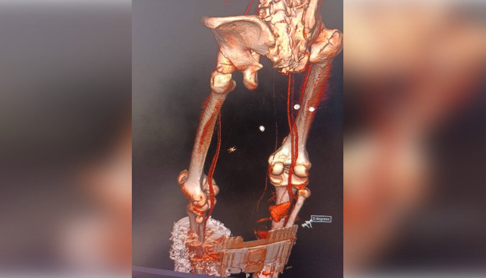 Астраханские медики спасли бойца СВО пострадавшего после атаки дрона