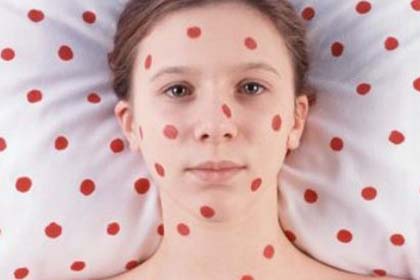 За три месяца корью заболели 145 астраханцев