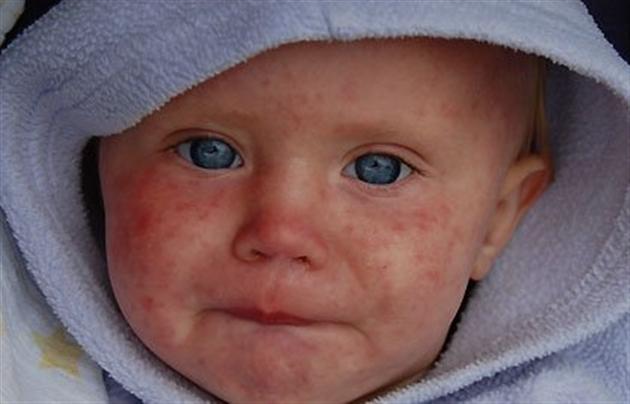 В Астраханской области новые случаи кори, теперь – в райцентрах