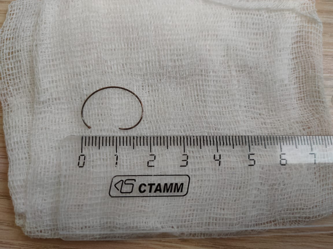 В Астрахани спасли десятимесячную девочку, проглотившую металлическое кольцо