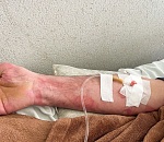 Астраханские медики спасли жизнь мужчине с 90 процентами ожогов тела