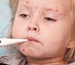 В Астрахани зарегистрирован случай кори