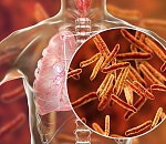 Астраханские врачи ускоренно определяют туберкулез с помощью новых технологий