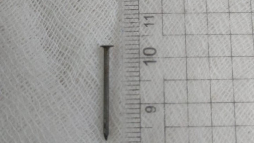  Астраханские врачи достали гвоздь из желудка годовалого ребенка 