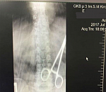 Астраханские хирурги "потеряли" зажим внутри пациентки