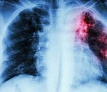 В Астрахани больного туберкулезом принудительно изолировали от общества