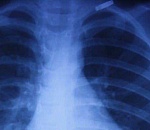 Соцсети: в Астрахани у школьного учителя нашли туберкулез