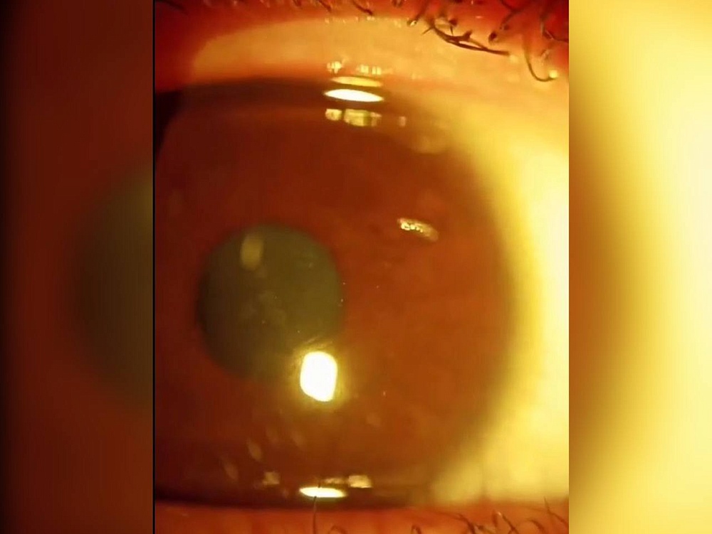 Астраханские медики достали личинку мухи из роговицы глаза ребёнка 