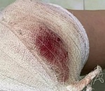 На астраханку набросились собаки и покусали её