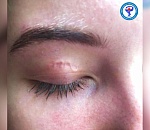 У астраханки из глаза достали 12-сантиметрового червя