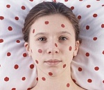 В Астрахани зарегистрированы новые случаи кори