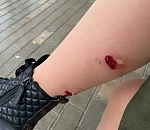 На астраханку набросилась стая собак, ее покусали 