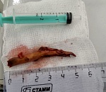 Врачи Александровской больницы достали у пациента из глаза 5-сантиметровую ветку