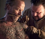 Грозит ли астраханцам эпидемия проказы? Мнение эксперта