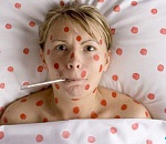 В Астрахани почти в два раза за год выросла заболеваемость ветряной оспой