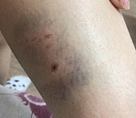 В Астрахани стая собак набросилась на ребенка и покусала его