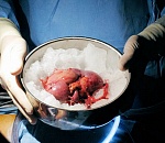 Астраханец получил семь лет строгача за потерянную почку