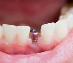 В астраханской стоматологии пациентке вставили поддельные импланты, из-за которых она потеряла почти все зубы