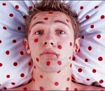 В Астраханской области продолжают фиксировать случаи кори