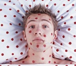 В Астрахани зарегистрировано 44 случая кори