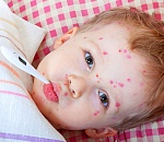 В Астрахани зарегистрировано три случая кори