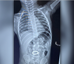 Астраханские медики достали из желудка ребенка 16 магнитов