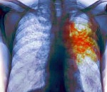 В астраханском лицее обнаружен туберкулез