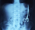 Возбуждено дело о забытом в теле астраханки во время операции зажиме 