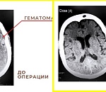 Врачи спасли 86-летнюю астраханку от тяжелого инсульта, удалив у нее огромную гематому