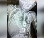 В Питере маленькой астраханке провели уникальную операцию 