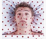 В Астраханской области неуклонно растет число заболевших корью