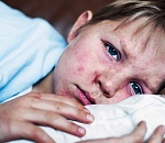 В Астраханской области 80 человек болеют корью