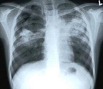 Астраханцы, больные туберкулезом, не лечатся, а врачи и не настаивают