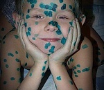 В Астраханской области регистрируются новые случаи кори