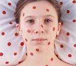 За три месяца корью заболели 145 астраханцев