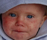 В Астраханской области новые случаи кори, теперь – в райцентрах